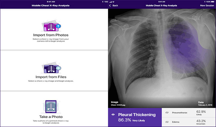 Mobile Chest X-Ray screenshot showcasing the differnt ways people can import photos into the app.