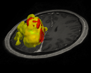 segmented glioblastoma