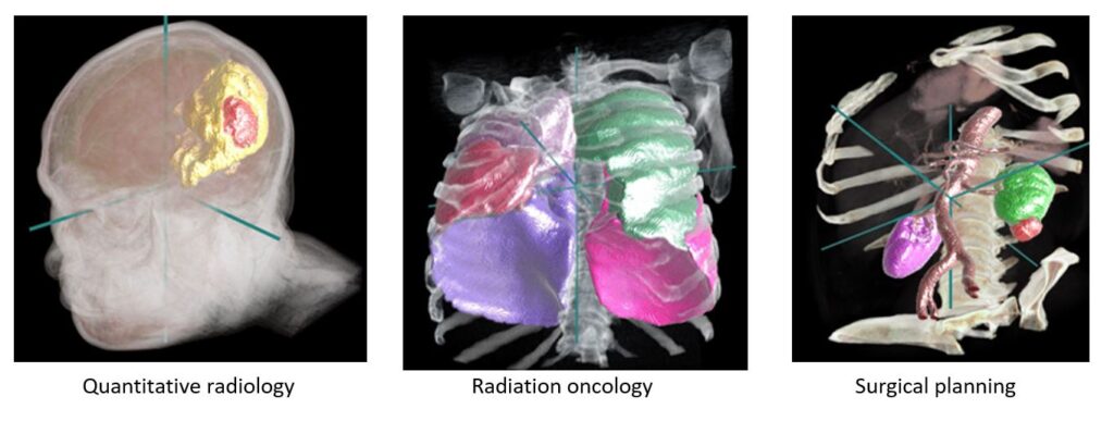 Potential applications for the InnerEye Deep Learning Toolkit include quantitative radiology for monitoring tumor progression, planning for surgery, and radiotherapy planning.