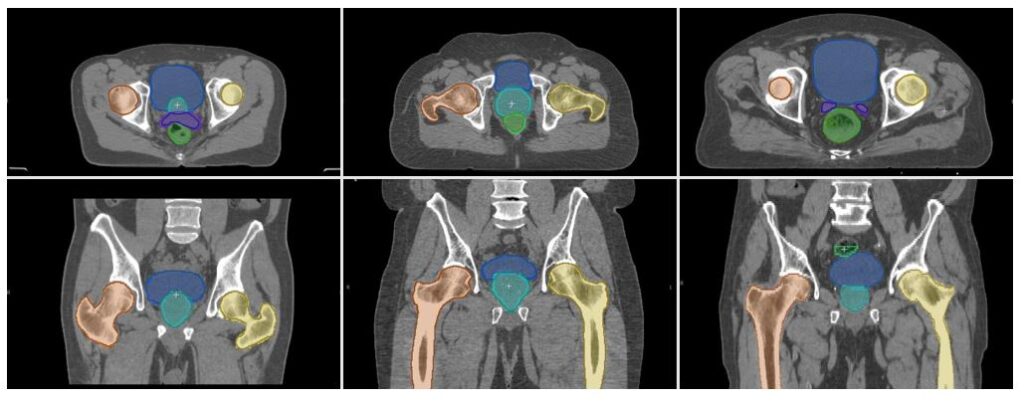 Six example images of head-and-neck and pelvis CT scans (three of each). Darker colored outlines and lighter colored outlines of similar areas in the scans show roughly the same area outlined. 